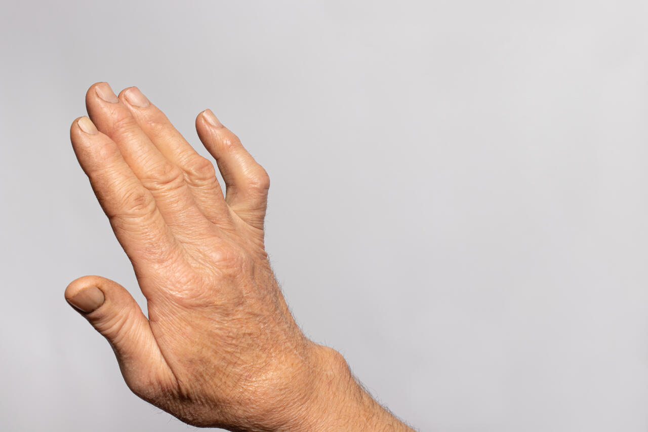 Artrosje eller slitasjegikt kan være smertefullt. Men det fins håp. Her kan du lese mer om hva artrose er og hvordan du kan trene hendene.